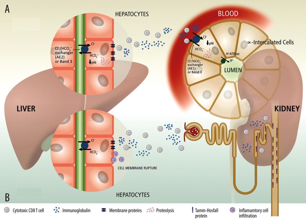 Possible mechanisms involved in the occurrence of dRTA in patients with autoimmune liver disease. (A) Reduced AE2 expression (congenital or caused by proteolysis) could be related to changes in intracellular pH. This could lead to protein mistargeting in liver cells and in kidney tubules, antigenic changes, and autoimmunity. The immunoglobulin G autoantibodies produced destroy the chloride/bicarbonate exchanger (band 3 isoform) present in hepatocytes and in the basolateral membrane in alpha-type intercalated cells in the collecting tubule [12]. (B) Hepatocyte damage can initiate an immune response due to the cross-reaction between membrane proteins in hepatocytes and Tamm-Horsfall glycoprotein in renal tubular cells [15].