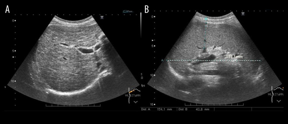 Ultrasonography showing moderately coarse liver parenchyma and a relatively smooth liver surface (A) as well as significant splenomegaly (15.9 cm in length) (B).