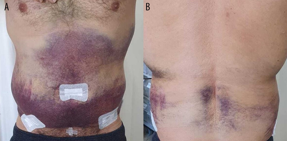 A 51-year-old man 4 days after abdominal liposuction with abdominal hematoma. Anterior (A), posterior (B) views of the large diffused abdominal hematoma. White stickers cover the surgical wounds.