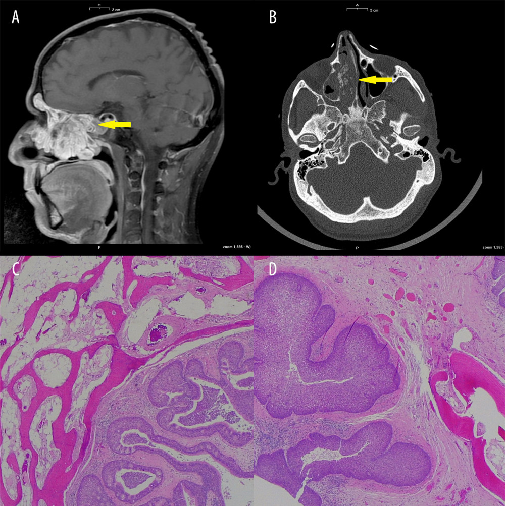 Sagittal MRI scan (A) and transverse CT scan (B) of the facial bones reveal a solid lobated lesion with extensive ossification, occupying most of the right nasal cavity. Erosion of the ethmoid bone and septal deviation are clearly visible (arrow). Histology shows an inverted papilloma with massive deposition of mature bone tissue. Hematoxylin and Eosin, 25× (C) and 100× (D) magnification.