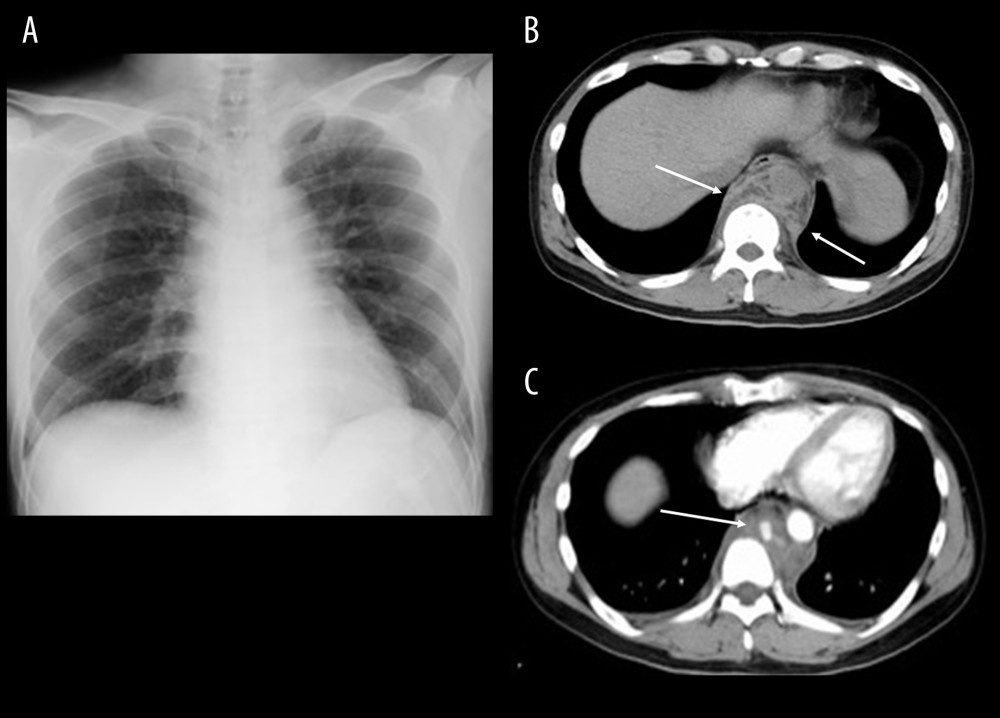 Chest X-ray (CXR) (A), non-enhanced computed tomography (CT) (B), and contrast-enhanced CT (C) at the presentation. (A) CXR did not show significant findings. (B) Thickening of the space between the aorta and vertebrae (arrow). (C) Contrast-enhanced CT showed a 4.3×2.7×7.0 cm mass enhanced by contrast media in the front of the 9th thoracic vertebrae body (arrow).