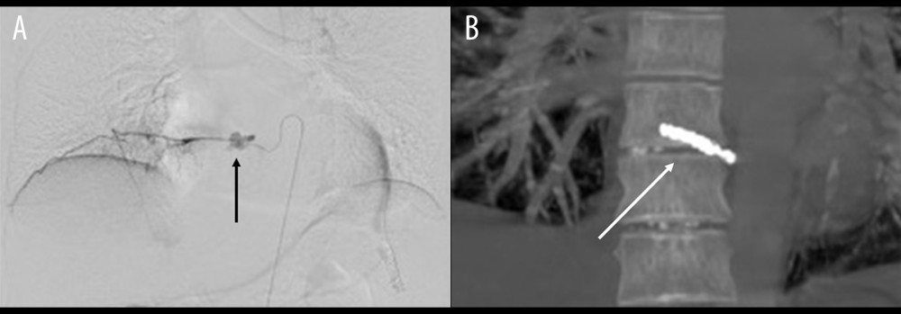 Angiography (A) and transcatheter arterial embolization (B). (A) Angiography showed extravasation in the right 9th intercostal artery. An obvious pseudoaneurysm was not found, and the Adamkiewicz artery was not visualized. (B) We used 8 microcoils for embolization.