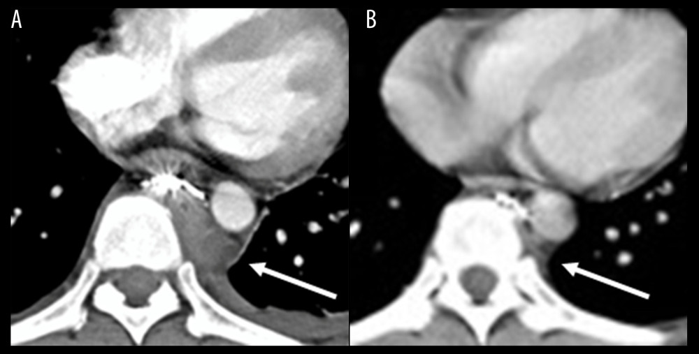 Computed tomography (CT) on day 7 (A), and day 37 (B). (A) Contrast-enhanced CT showed a small amount of hemothorax on the left side, although the hematoma in front of the vertebrae had decreased. (B) The hematoma and hemothorax had disappeared, and no masses were noted.