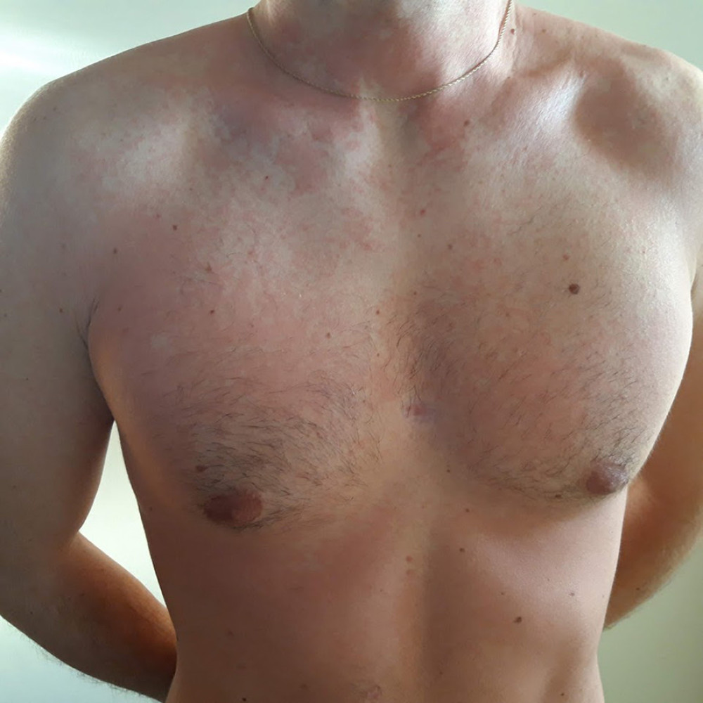 36-year-old man with an adverse reaction to histamine in food and beverages. Skin reaction.