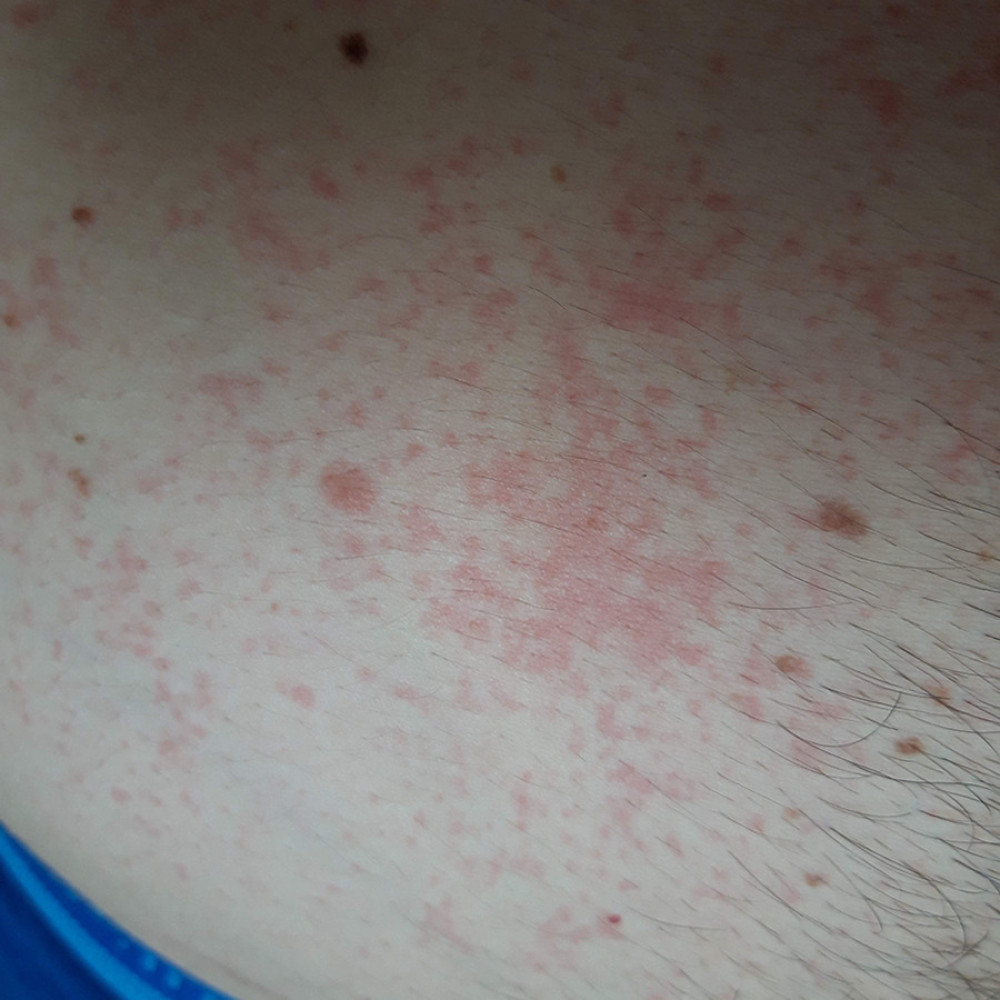 36-year-old man with an adverse reaction of the skin to histamine in food and beverages. The erythematous rash involves the neck, chest, inner arms, and thighs, but not the face. It fades under pressure.