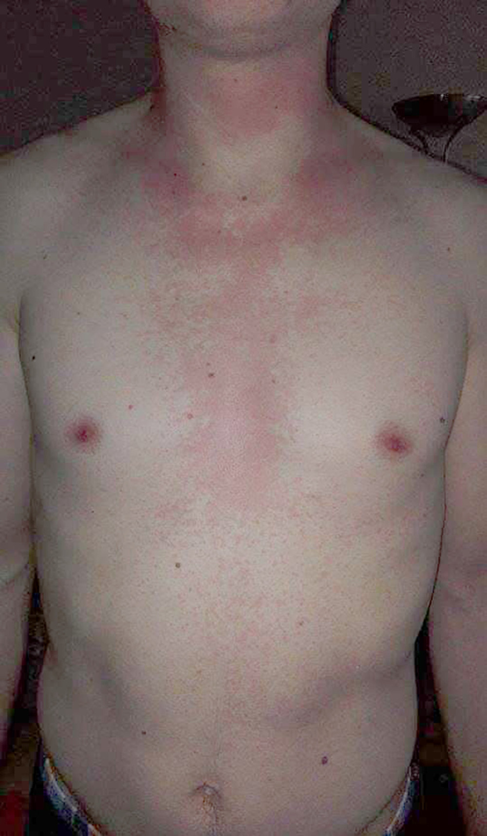 34-year-old man with adverse reaction to histamine in food and beverages. The first brother of the patient also had an adverse reaction to histamine in food and beverages, with all the accompanying symptoms.