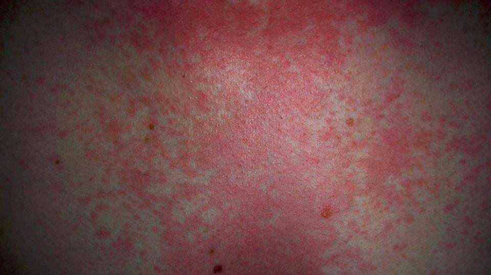 34-year-old man with histamine adverse reaction (first brother of the patient).
