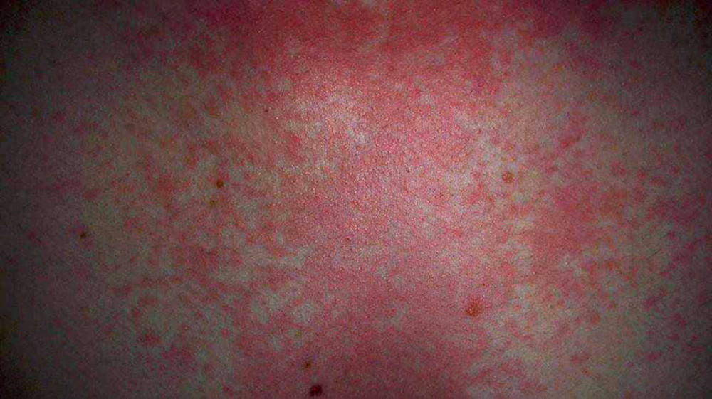 34-year-old man with histamine adverse reaction (first brother of the patient).