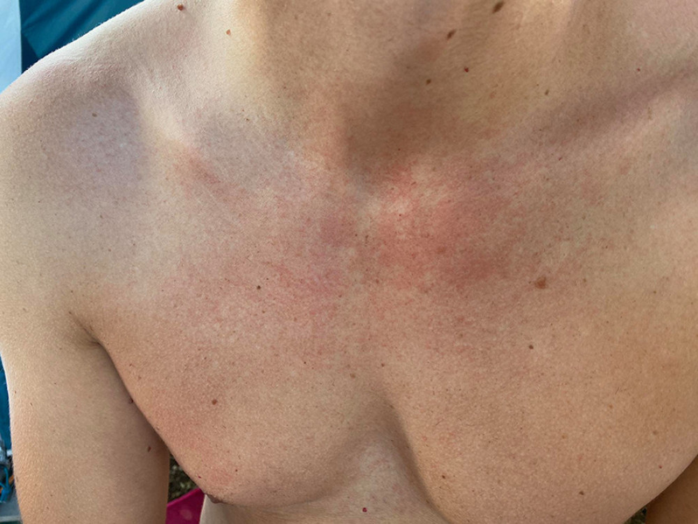 A 31-year-old man with histamine adverse reaction. The second brother of the patient also had an adverse reaction to histamine in food and beverages, but it appeared less often.
