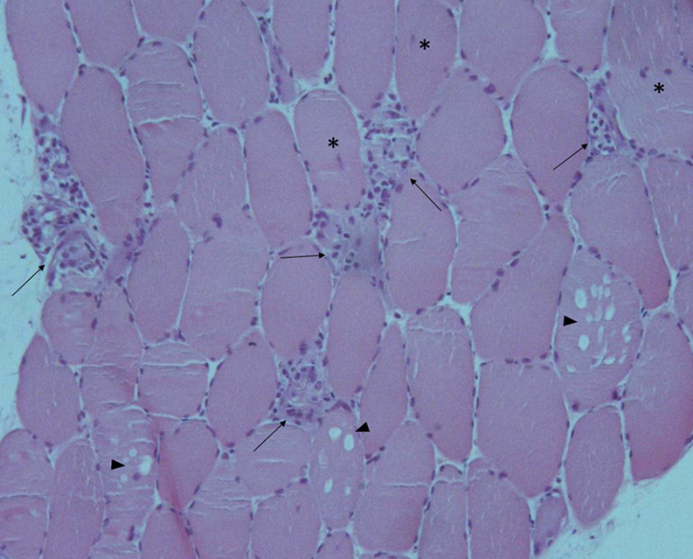 Hematoxylin and eosin staining on muscle biopsy showing multiple fiber cells with severe necrotic, degenerative changes and inflammatory cells infiltrate (arrows), some with large sarcoplasmic vacuoles (arrowheads) and isolated inner nuclei (black stars).