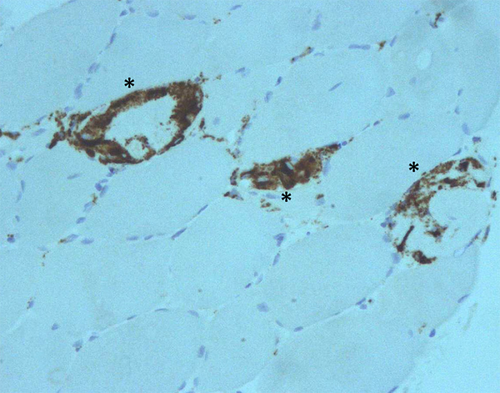Immunohistochemistry on muscle biopsy for CD68 shows endomysial infiltrate especially characterized by CD68 macrophages (black stars).
