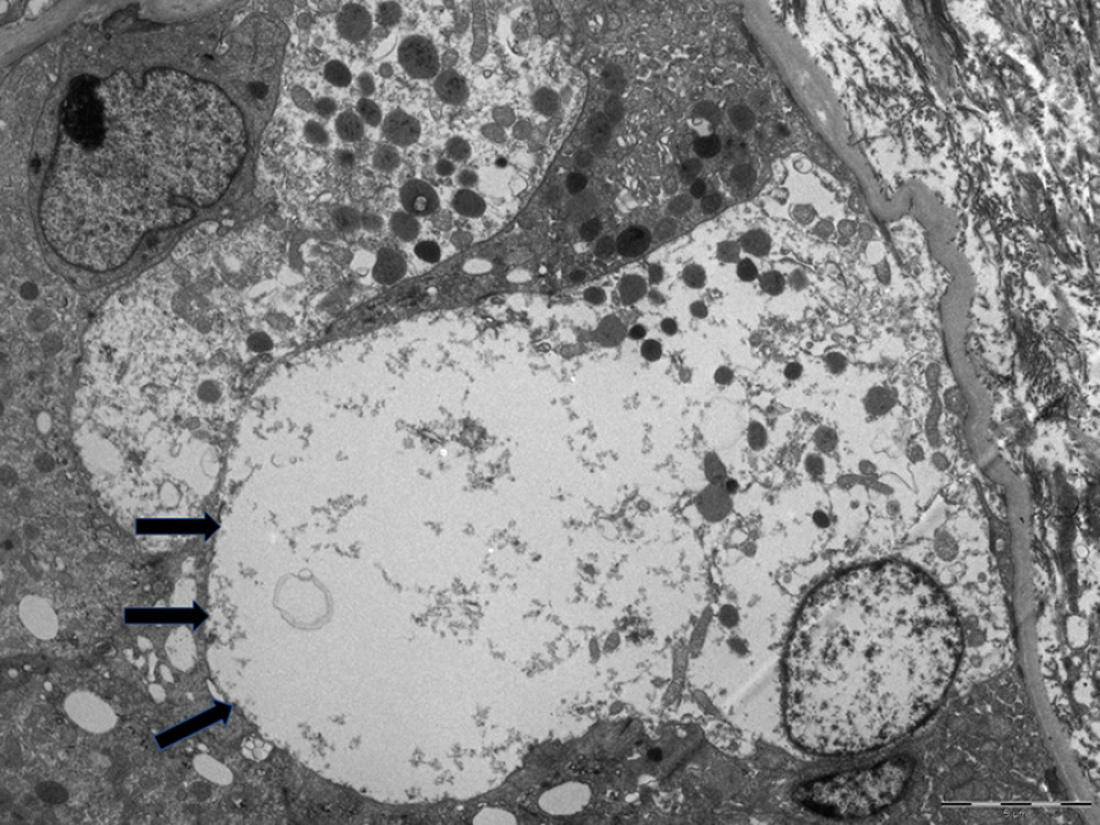 Electron microscopy of kidney biopsy samples. The arrows show a necrotic tubular epithelial cell.