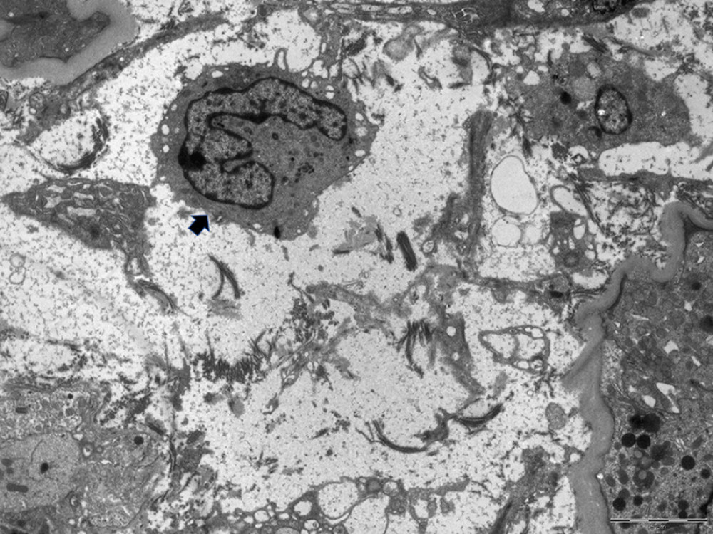 Electron microscopy. The extracellular space of kidney biopsy sample is enlarged due to interstitial edema and inflammatory infiltrate; the short arrow indicates a monocyte with horseshoe-shaped nucleus.