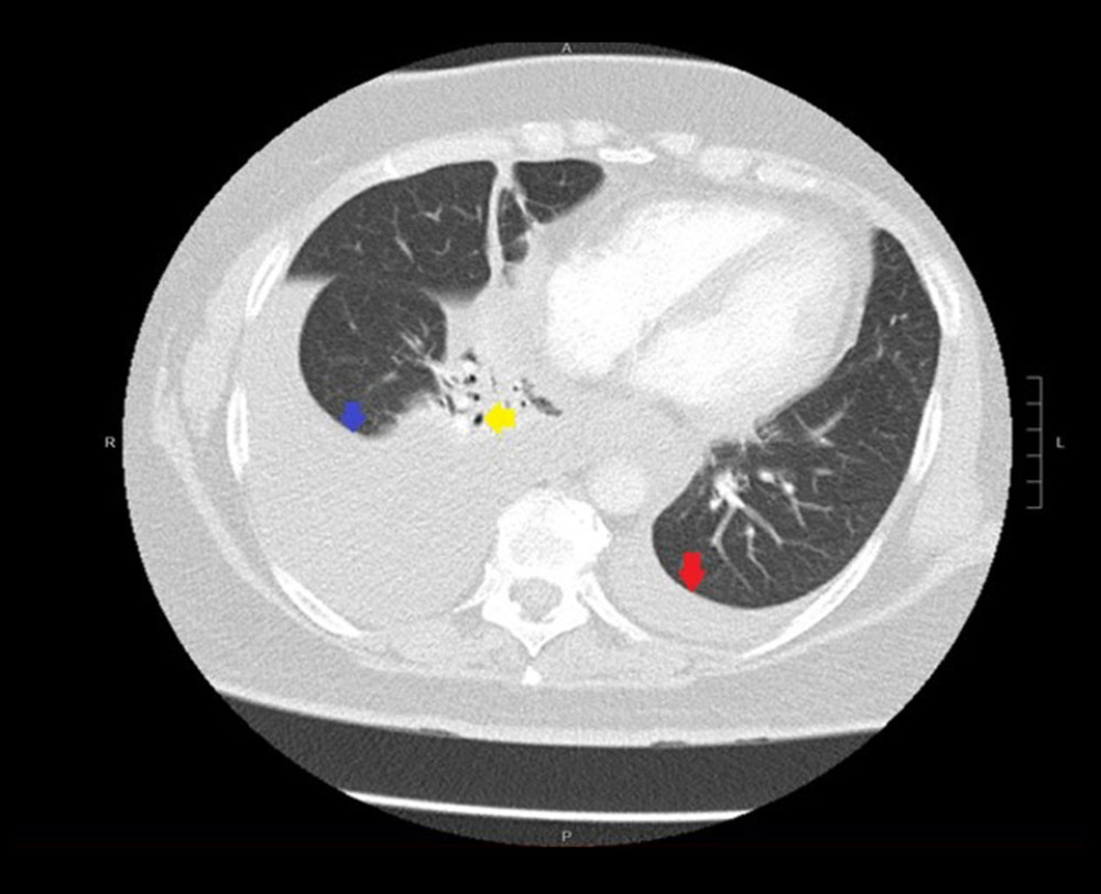 Computed tomography angiography (CTA) of the chest of a 58-year-old woman with gallstones, chronic pancreatitis, and pancreatic pseudocyst presenting with pleural effusion due to a pancreatopleural fistula. Transverse CT imaging of the thorax shows a right pleural effusion (blue arrow), a small left pleural effusion (red arrow), and a partial collapse of the right lower lobe with air bronchograms (yellow arrow).