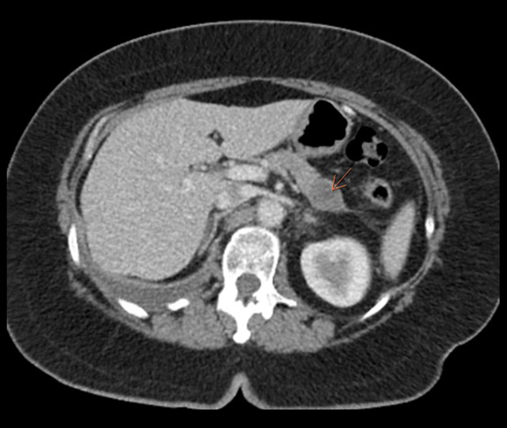 CT of abdomen and Pelvis of a 58-year-old woman with gallstones, chronic pancreatitis, and pancreatic pseudocyst presenting with pleural effusion due to a pancreatopleural fistula. CT imaging shows a 2.8×2.2 cm pancreatic pseudocyst in the inferior part of the pancreatic body (orange arrow).
