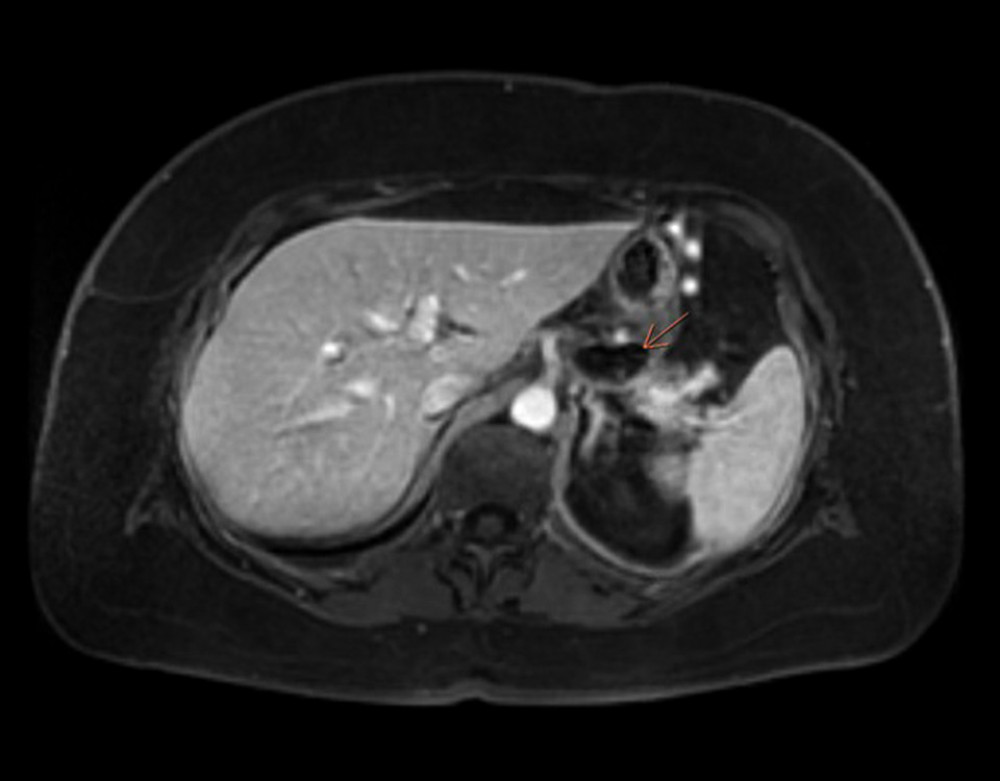 Enhanced MRI of the abdomen of a 58-year-old woman with gallstones, chronic pancreatitis, and pancreatic pseudocyst presenting with pleural effusion due to a pancreatopleural fistula. Imaging shows another fluid collection in the body of the pancreas (orange arrow).