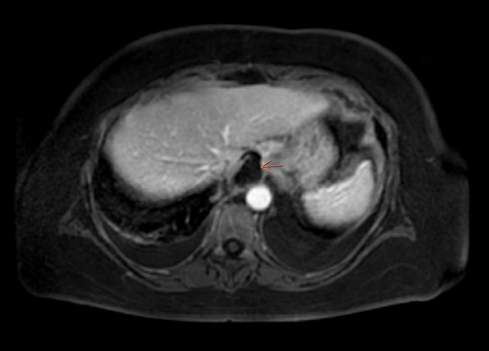Enhanced MRI of the abdomen of a 58-year-old woman with gallstones, chronic pancreatitis, and pancreatic pseudocyst presenting with pleural effusion due to a pancreatopleural fistula. Imaging shows another fluid collection at the esophageal hiatus (orange arrow).