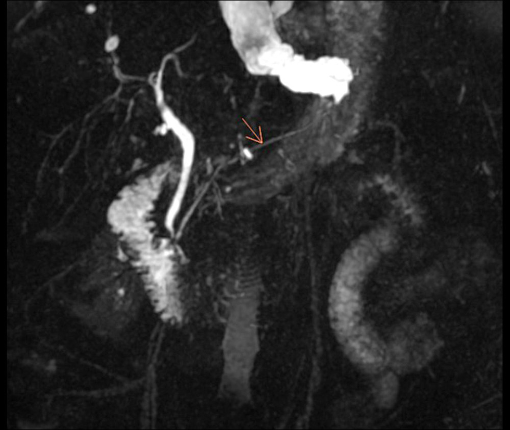 Magnetic resonance cholangiopancreatography (MRCP) of a 58-year-old woman with gallstones, chronic pancreatitis, and pancreatic pseudocyst presenting with pleural effusion due to a pancreato-pleural fistula. The MRCP shows the pancreatic duct (orange arrow) extending toward the collection.
