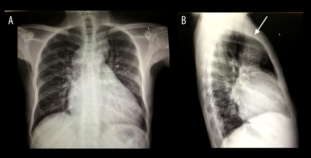 PA (A) and lateral (B) chest X-rays of the patient showing an opacity in the anterosuperior mediastinum, and the assumed direction of the stab (white arrow on lateral X-ray).