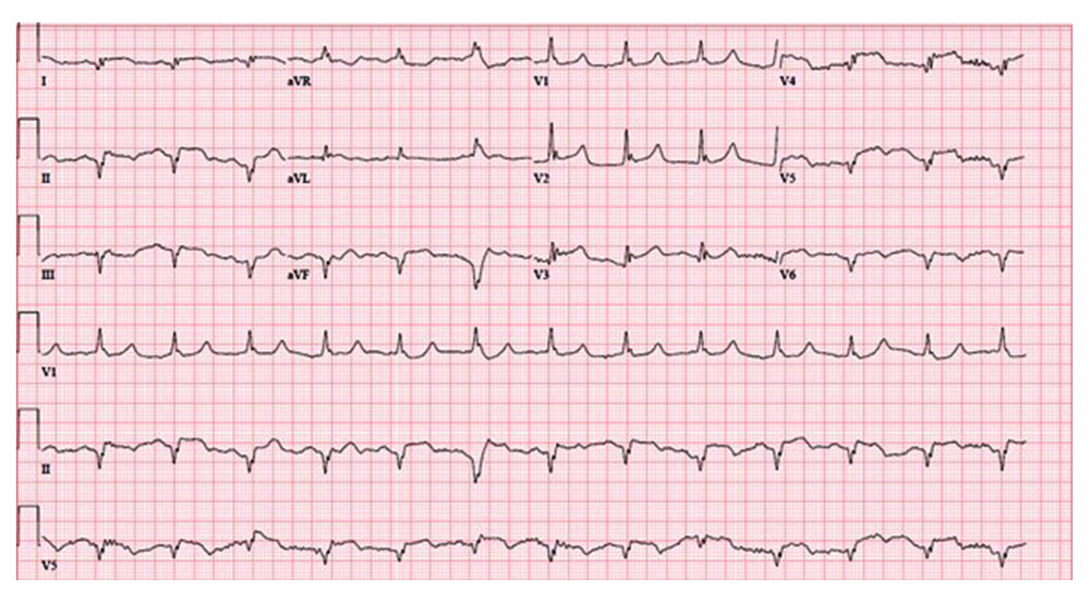 Acute myocardial infract with diffuse ST elevation.
