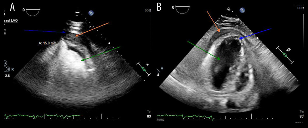 Apical 4-chamber view echocardiogram. Orange arrow showing pericardial effusion. Blue arrow showing aneurysmal segment with site of suspected contained rupture and neck of aneurysmal segment measurement. (A) Green arrow showing LV filled with contrast, (B) green arrow showing LV without contrast.