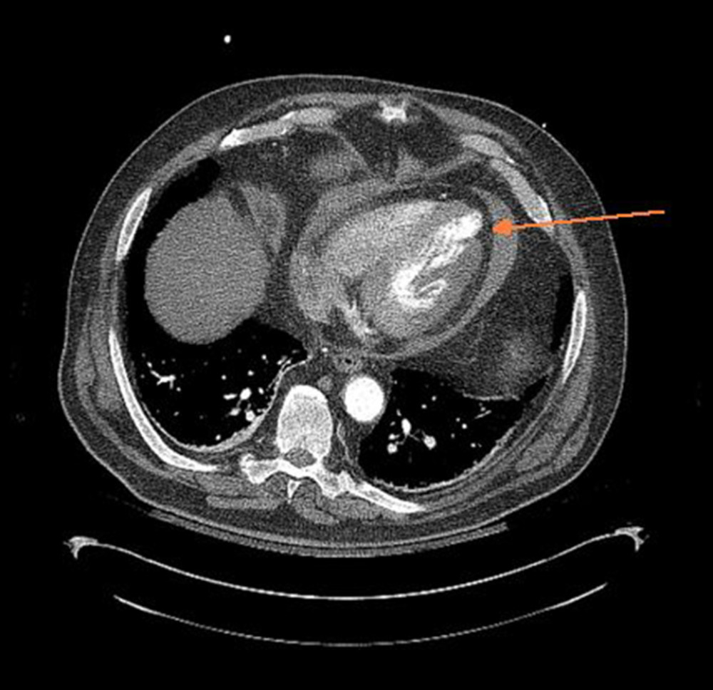 Small pericardial effusion, with moderate internal density. This is nonspecific but can be seen in the setting of an exudative pericarditis. Arrow pointing to area with notable defect concerning for possible contained rupture.