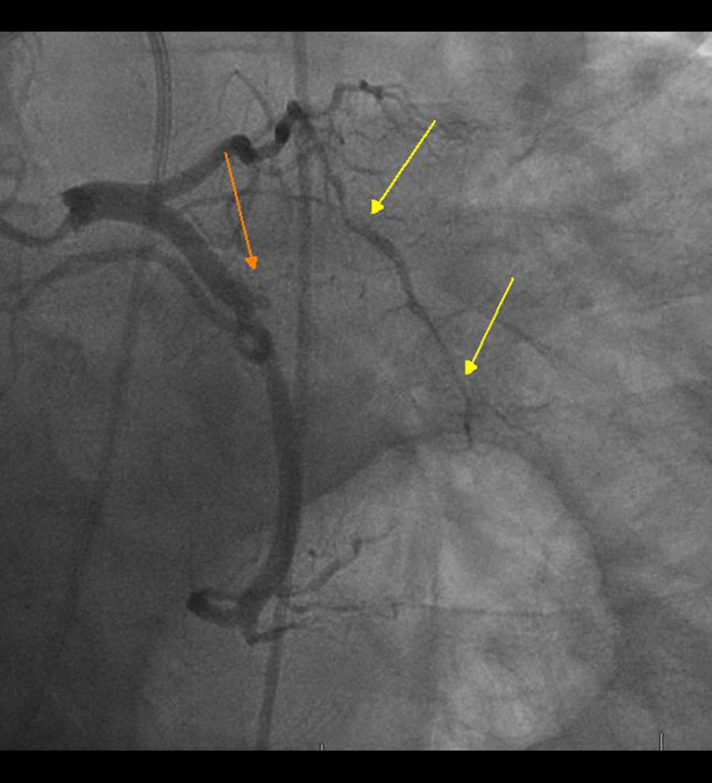 Orange arrow showing complete occlusion of the obtuse marginal branch. Yellow arrows showing severely diseased middle and distal segments of left anterior descending artery.