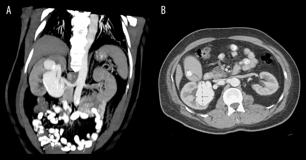 (A, B) CT/CTA showing a giant multi-saccular right RAA (5.3×6.7×10.2 cm) extending in the renal pelvis and an accessory artery (arrow) from the aorta to the upper pole of the right kidney.