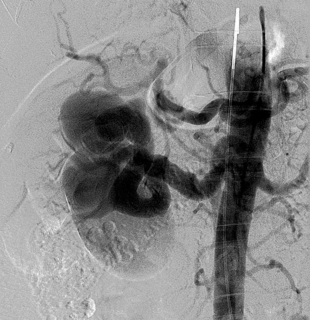DSA showing a large multi-saccular aneurysm of the right renal artery with an accessory artery to the upper pole of the right kidney.