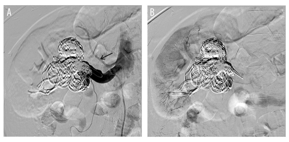 (A, B) A final intraoperative DSA showing the complete occlusion of the RAA filled with coils and a preserved right upper pole accessory artery (arrow) with a good contrast enhancement of renal parenchyma in the upper and middle part.
