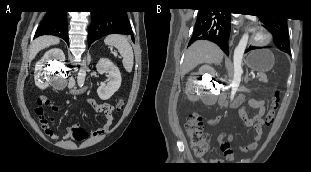 (A, B) Four-month follow-up abdominal CT/CTA showing coil mass and complete occlusion of the RAA and the preserved right kidney parenchymal perfusion.