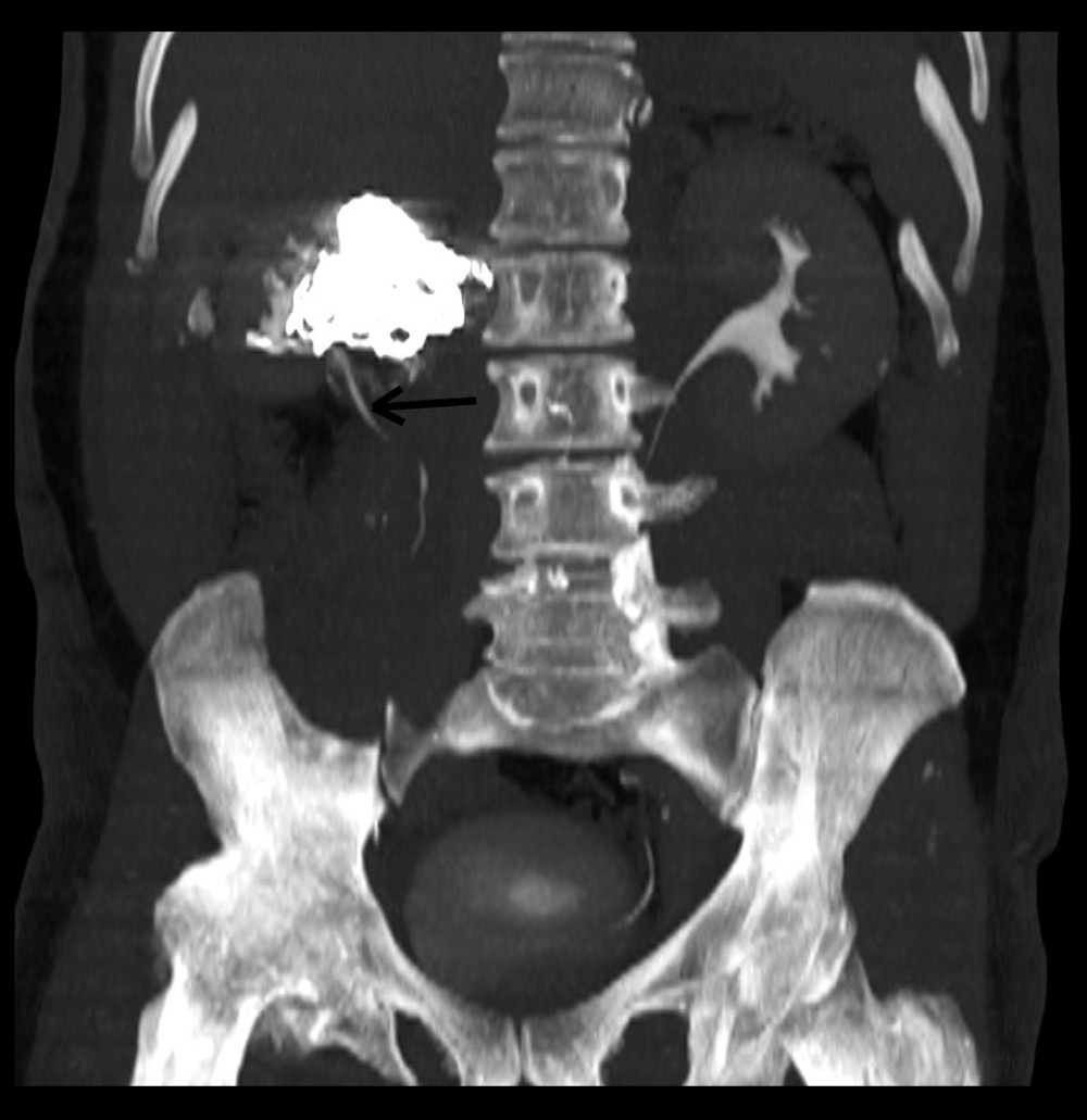 Four-month follow-up abdominal CT/CTA showing contrast excretion in the right ureter (arrow).