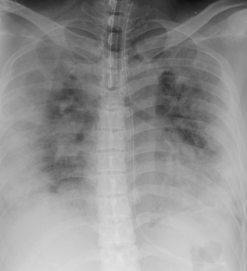 Chest X-ray on arrival showing peripheral bilateral ground-glass opacities.
