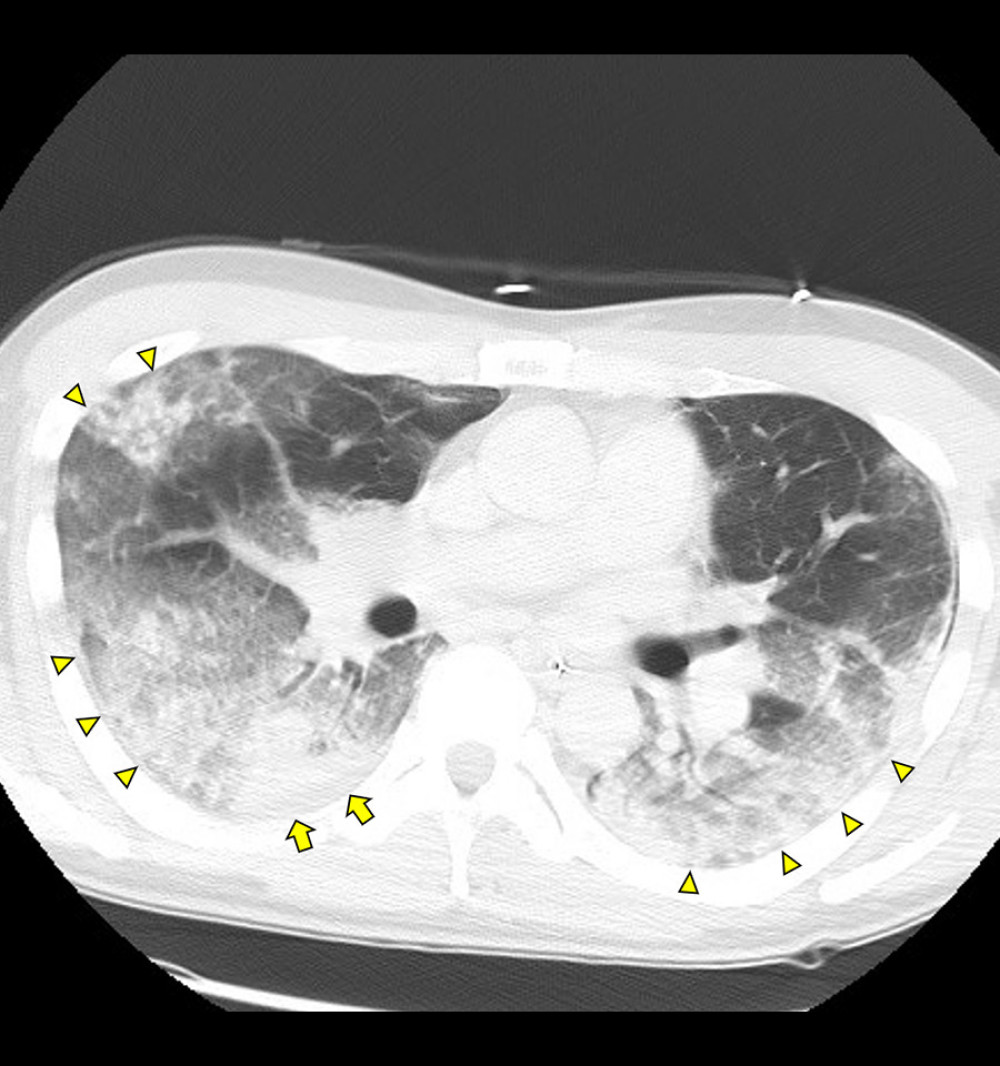 Computed tomography on arrival showing patchy bilateral ground-glass opacities (arrow heads) and consolidations (arrows).