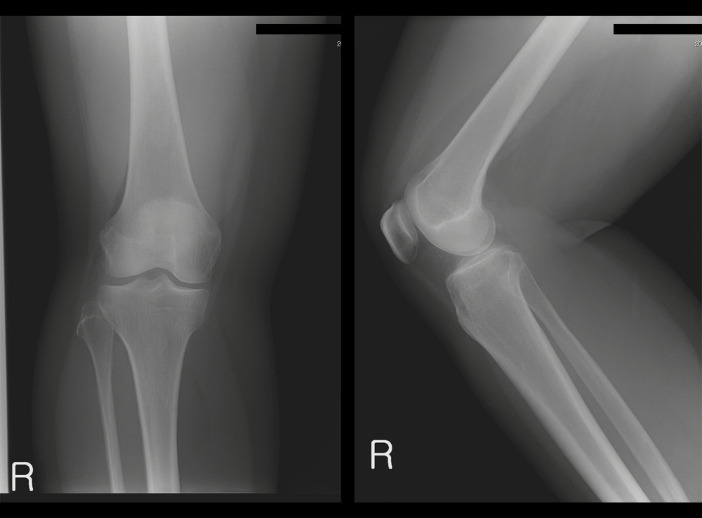 Plain radiographs of the knee joint at the first visit showed no abnormalities caused by the soft tissue tumor or osteoarthritis.