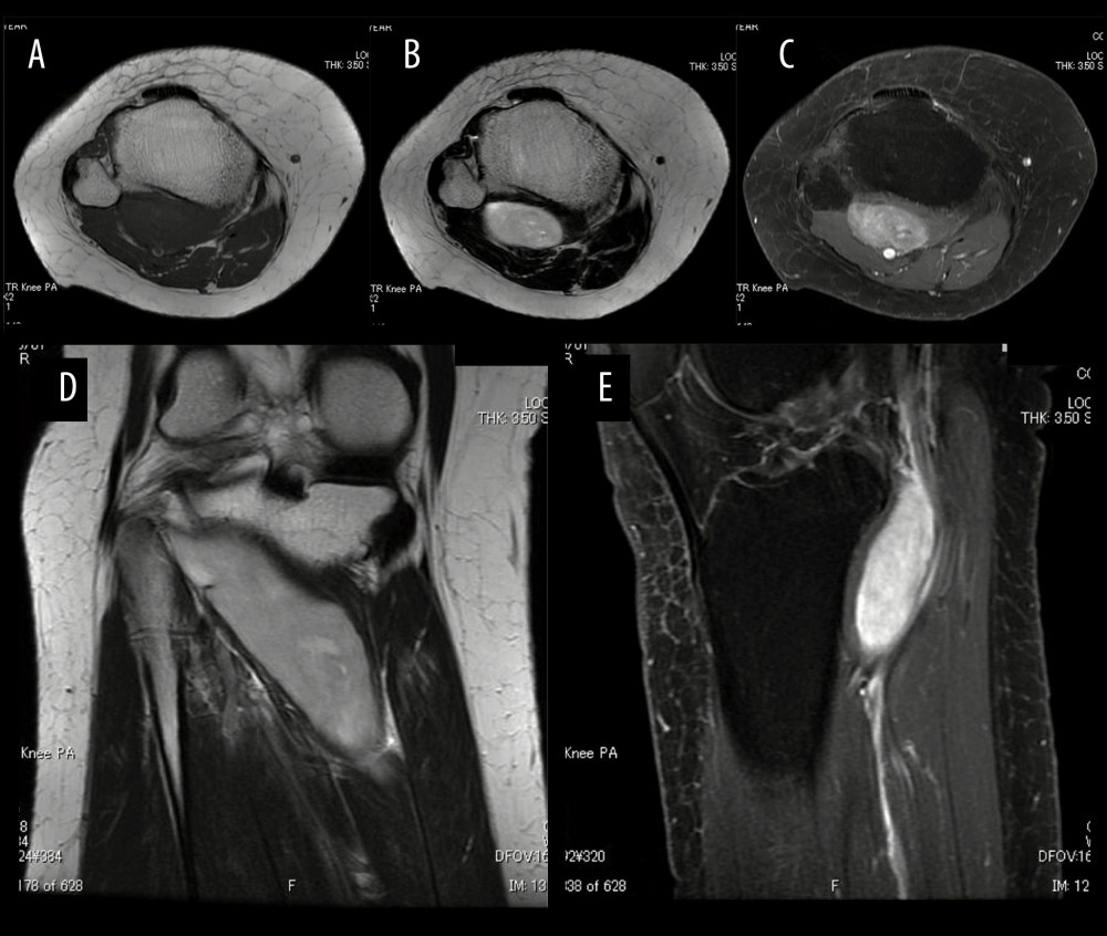 Magnetic resonance imaging (MRI) showed a tumor with clear margins in the popliteus muscle. (A, B) T1- and T2-weighted axial images, respectively. (C) Gadolinium-enhanced fat-suppressed T1-weighted axial image. (D) T2-weighted coronal image. (E) T2-weighted sagittal image with fat suppression.