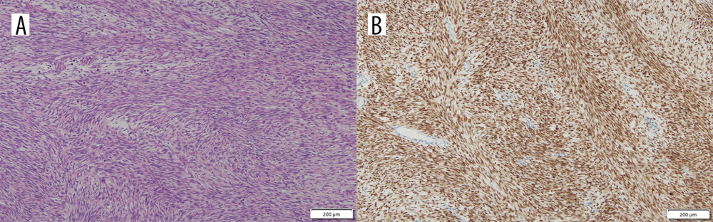 (A) Microscopic image of the biopsy specimen (hematoxylin-eosin; HE) showed a densely cellular monomorphic population of spindle cells with focally whorled areas. (B) Immunohistochemical staining with an anti-SS18-SSX fusion-specific antibody revealed strong diffuse nuclear positivity.