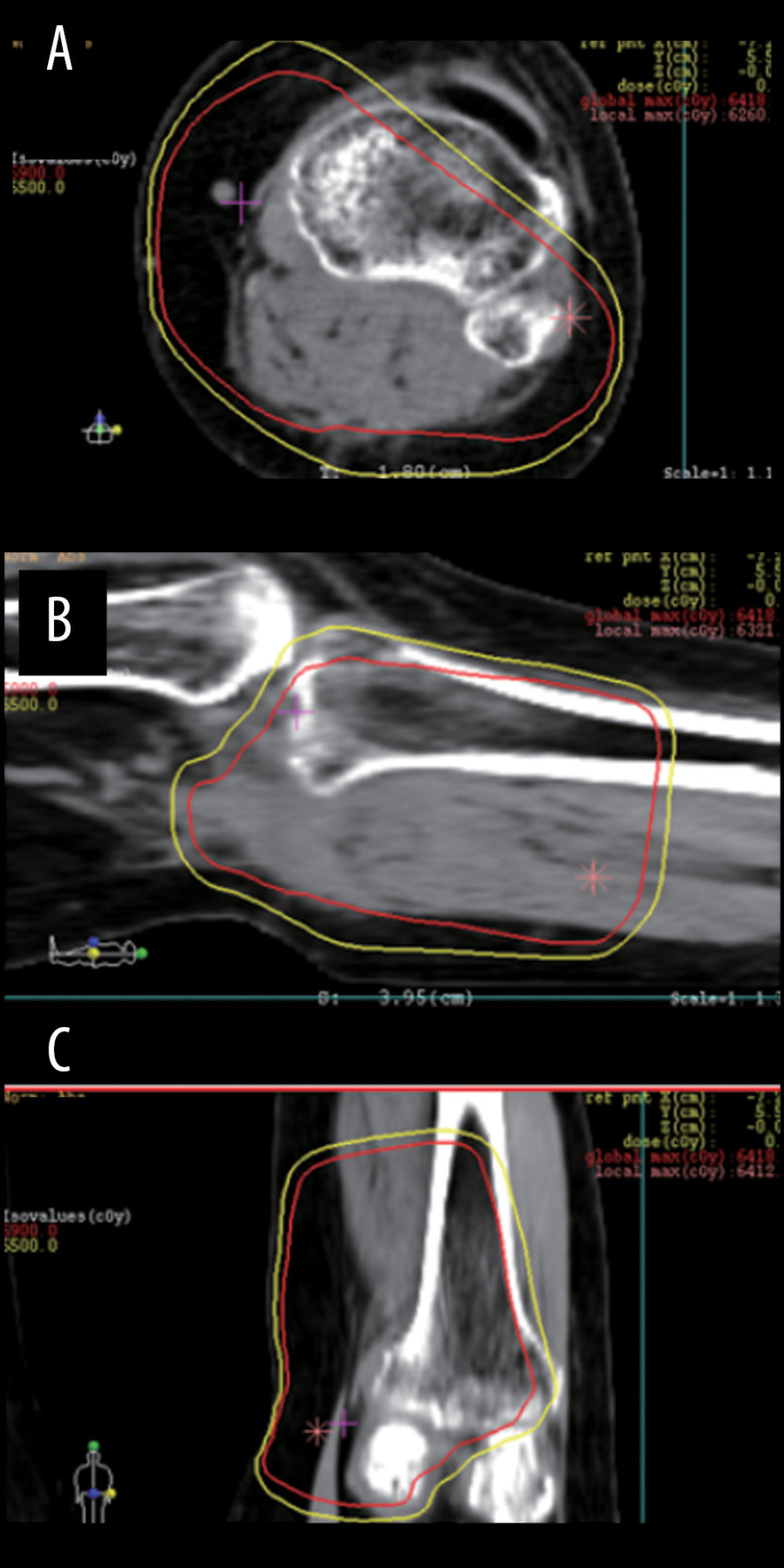 Dose distribution of the radiation therapy was shown. Note the dose of 59 Gy was delivered to the posterior segment of the tibia (red line). (A) Axial view, (B) sagittal view, and (C) coronal view.