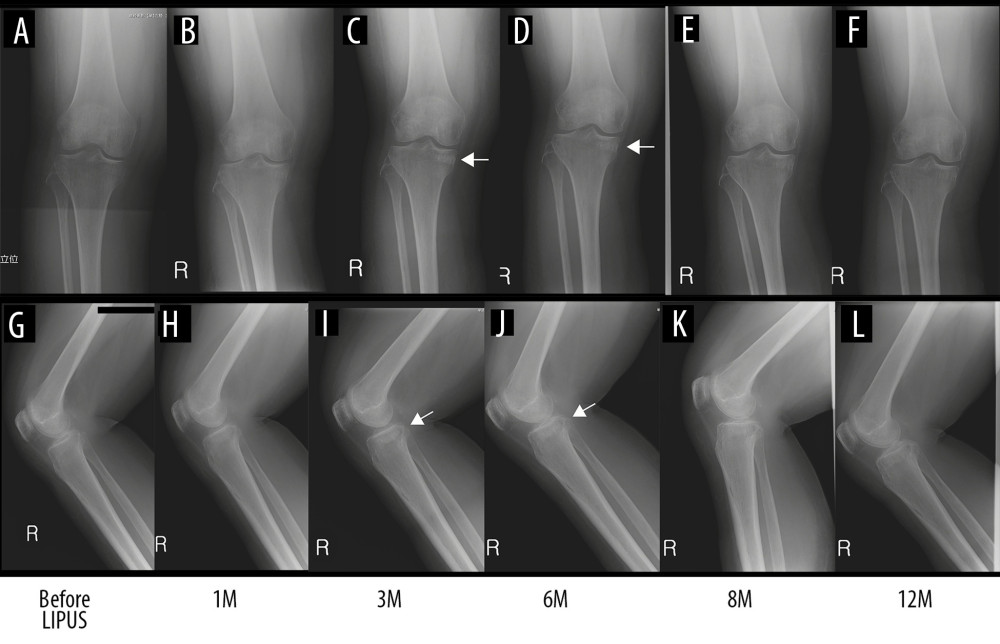 Anteroposterior (A–F) and lateral (G–L) radiographs of the right knee taken immediately after the onset of the knee pain, and 1 month, 3 months, 6 months, 8 months, and 1 year after initiation of LIPUS therapy. Obvious callus formation around the fracture site was observed at 3 and 6 months after treatment (arrows). After 1 year, remodeling of the fracture callus was complete. LIPUS, low-intensity pulsed ultrasound; M, months.
