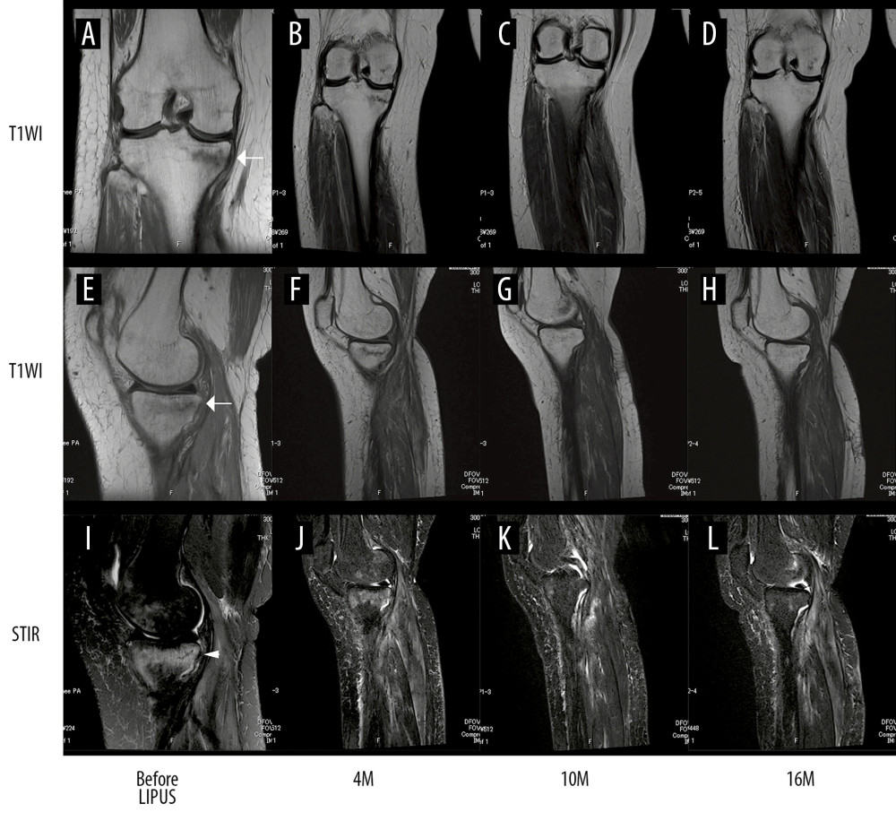 MRI signals and time course of the resolution for the insufficiency fracture in the proximal medial tibia. Coronal T1-weighted images (A–D), sagittal T1-weighted images (E–H), and sagittal T2-weighted images with fat suppression of the right knee taken immediately after the onset of the knee pain, and 4 months, 10 months, and 16 months after initiation of LIPUS therapy. Low signal intensity (A and E, arrows) on T1-weighted images and high signal intensity (I, arrowhead) on short TI inversion recovery (STIR) images in the proximal medial tibia disappeared over time. T1WI, T1-weighted images; STIR, short TI inversion recovery; LIPUS, low-intensity pulsed ultrasound; M, months.