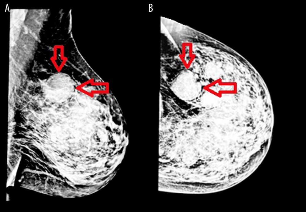 Mammographic depiction of left breast: (A) mediolateral view; (B) craniocaudal view. The arrows point toward the large mass in the upper left quadrant of the breast.