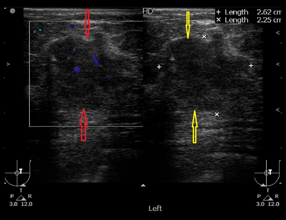 Ultrasonography depicting a large hypoechoic lobular mass with indistinct margins and posterior acoustic shadowing located in the upper outer quadrant of the left breast. The red and yellow arrows point toward its upper and lower limits.