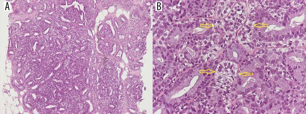 Hematoxylin and eosin staining (A) ×100 and (B) ×400, showing characteristics of adenomyoepithelioma from core biopsy. The yellow arrows point toward the lighter-colored myoepithelial cells.