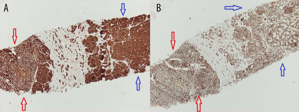 (A) Immunohistochemical staining for keratins AE1/AE3 ×40 from core biopsy. Depicted are broad lesions characteristic of adenomyoepithelioma (AME) (blue arrows) and adenoid cystic carcinoma (ACC) (red arrows). (B) Immunohistochemical staining for protein p63 ×40 from core biopsy. The blue arrows show the AME area, the red arrows show the ACC.
