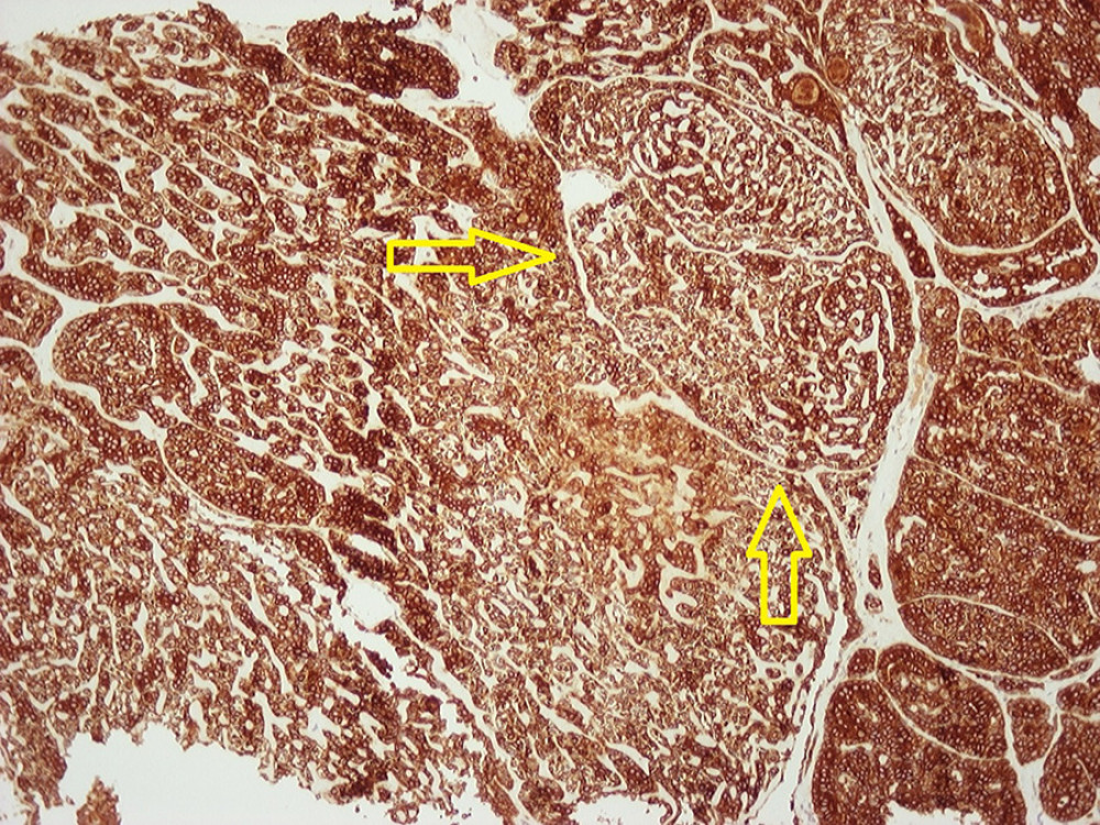Immunohistochemical staining for keratins AE1/AE3 ×100 from core biopsy. The yellow arrows point toward the characteristic cribriform structure of adenoid cystic carcinoma.
