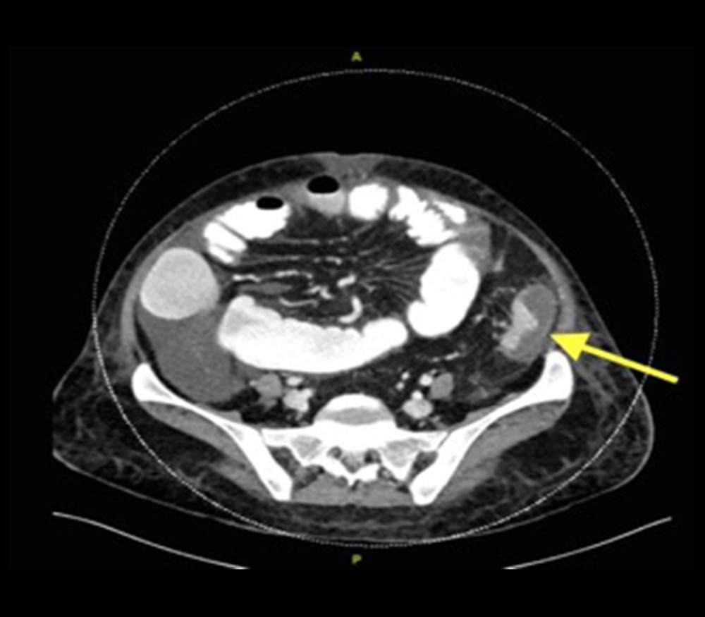 Computed tomography of the abdomen showing a distal descending colon mass (yellow arrow).