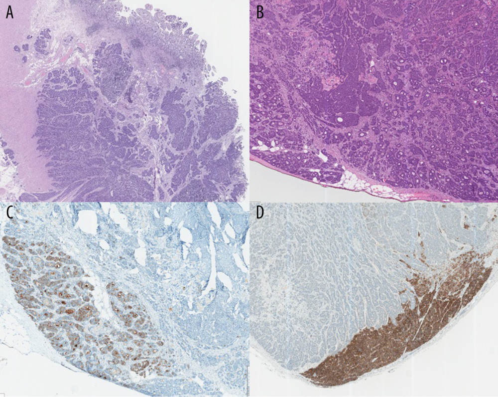 Histopathology slides of the mid-transverse colon stricture (A, B) shows the poorly-differentiated neoplasms of the 2 components. (C, D) Cells shows positivity focally for synaptophysin and CD56. (Hematoxylin-eosin and IHC, original magnifications ×4 [A, B, and D] and ×20 [C]).
