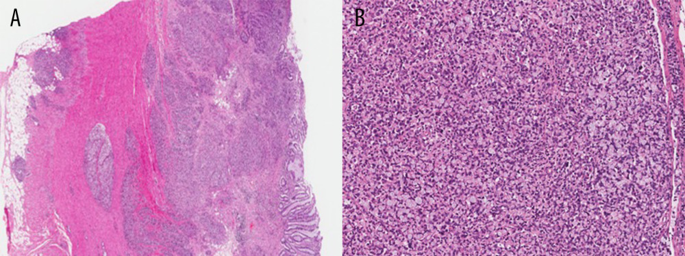 (A, B) Histopathology slides of the splenic flexure colon mass showing a poorly-differentiated carcinoma with signet ring cell morphology. (Hematoxylin-eosin, original magnifications ×4 [A] and ×40 [B]).