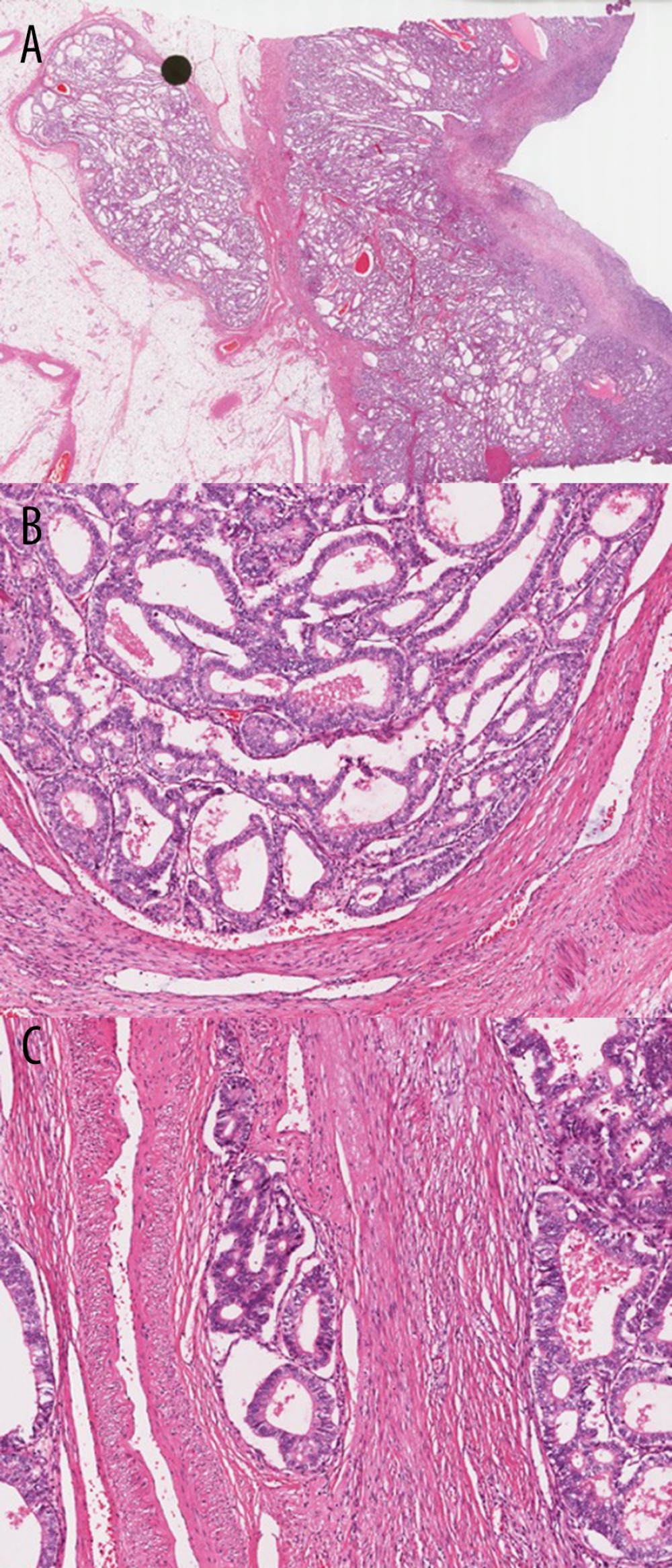 Histopathology slides of the distal descending colon mass shows (A, B) adenocarcinoma with moderate differentiation, and (C) demonstrates vascular invasion. (Hematoxylin-eosin, original magnifications ×4 [A], [B] ×20, and ×40 [C]).