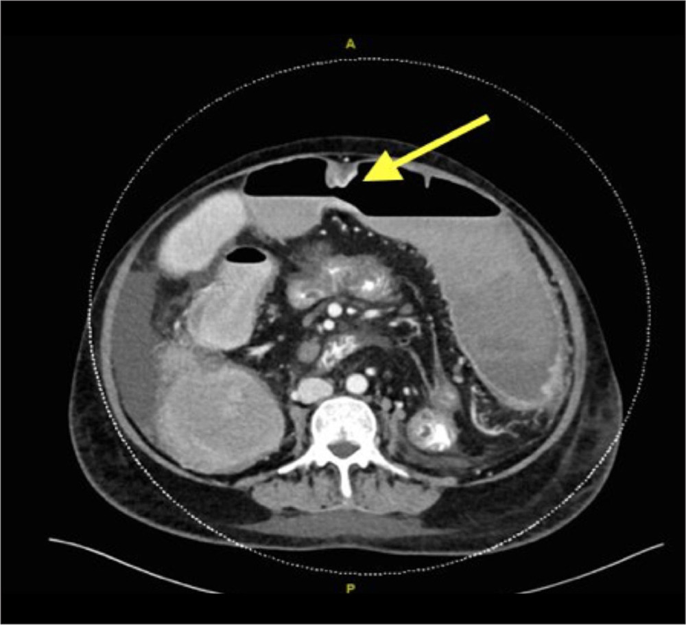 Computed tomography of the abdomen showing a mid-transverse colon malignant stricture (yellow arrow).